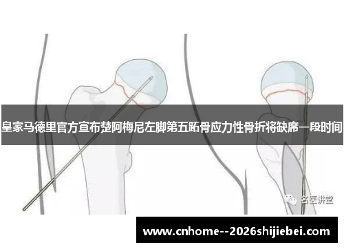 皇家马德里官方宣布楚阿梅尼左脚第五跖骨应力性骨折将缺席一段时间